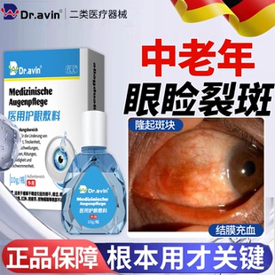 眼睑裂斑眼底黄斑病变可搭眼药水滴眼液眼白发黄眼睛清澈去黄LJ