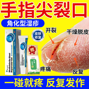 手指尖角化型手部湿疹手癣膏脱皮干裂真菌感染手指开裂手脚增厚QQ