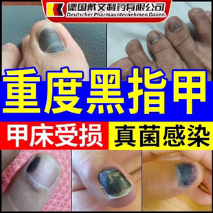 黑指甲脚指专用甲变黑发黑淤血发黑痣可搭膏药贴甲母痣黑线挤压CS