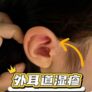 耳朵湿疹真菌性外耳道炎真菌感染膏药贴里外面痒皮屑专用CS