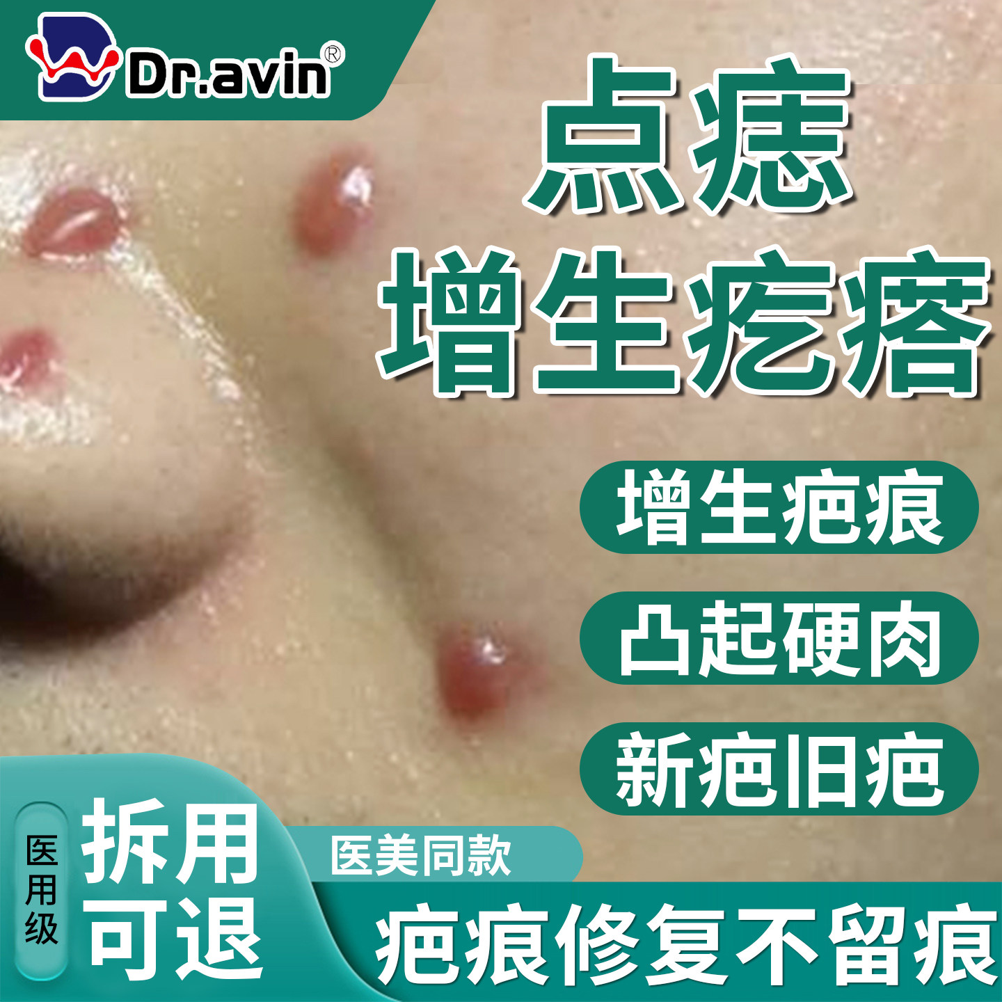 点痣后增生疤痕凸起去除疙瘩修复除疤膏激光去红印贴硬肉祛疤膏QQ