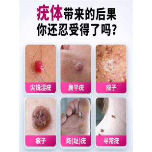 南京同仁堂医用疣凝胶脱落型膏IIG祛扁平疣寻常状瘊肉丝尖锐湿疣