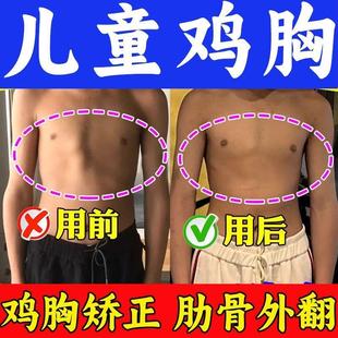 鸡胸矫正器儿童青少年肋骨外翻胸骨凸起畸形漏斗胸收缩固定带膏贴