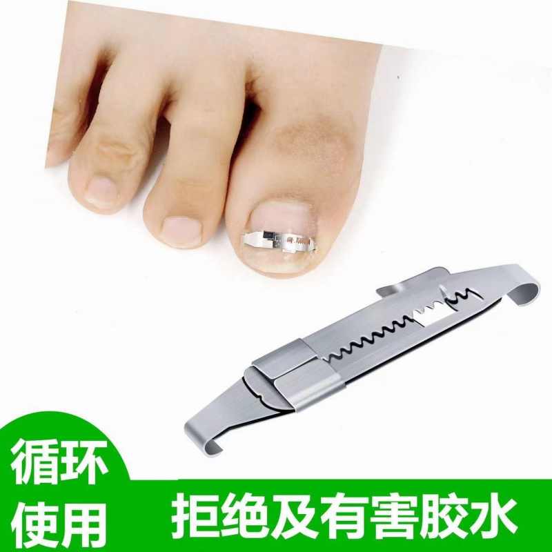 甲沟矫正器嵌甲矫正器正甲扣脚趾