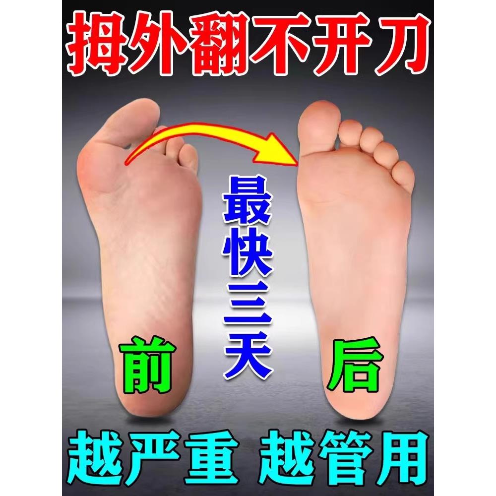 拇指外翻矫正器中药贴冶大脚骨大脚趾变形痛疼贴大指姆外翻药膏ZZ
