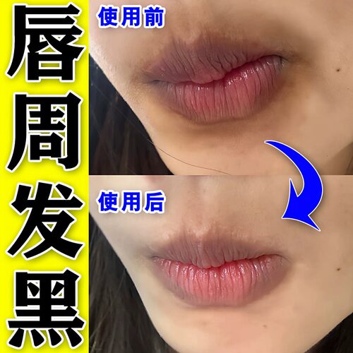 唇周黑改善嘴唇黑色素去除嘴角暗