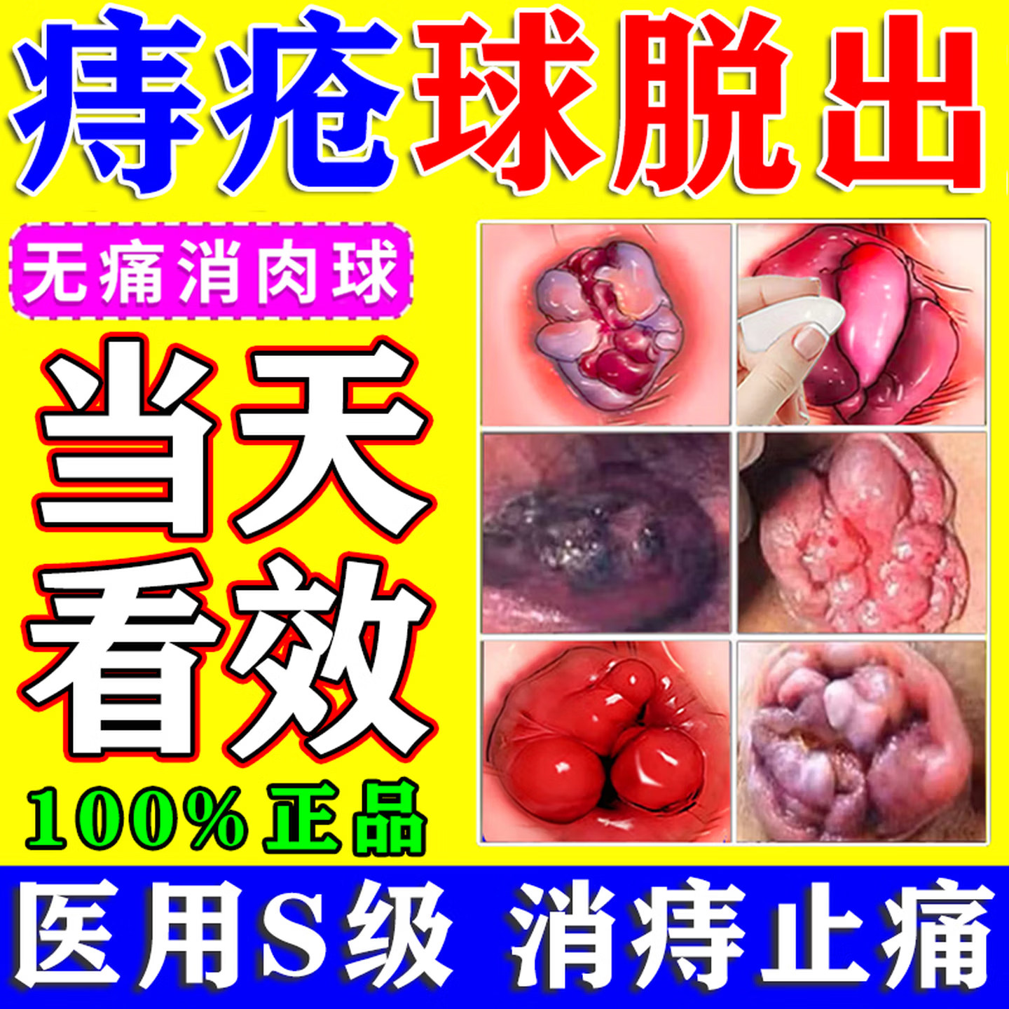 痔疮特药效排行榜第一名肛泰痔疮栓正品专用肉球大便出血消肿神器