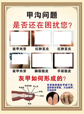 甲沟炎灰指甲的危害高清海报脚气的危害案例广告宣传贴画挂画包邮