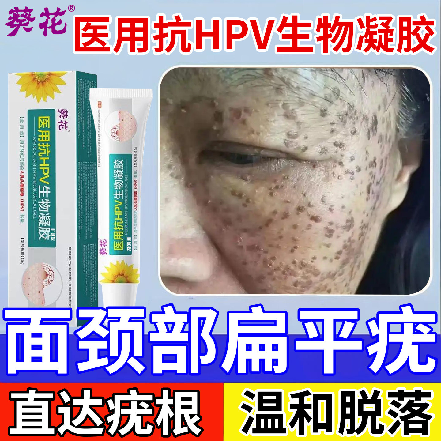 葵花医用抗hpv生物凝胶扁平疣无忧去除药膏祛疣瘊丝状疣去小肉粒
