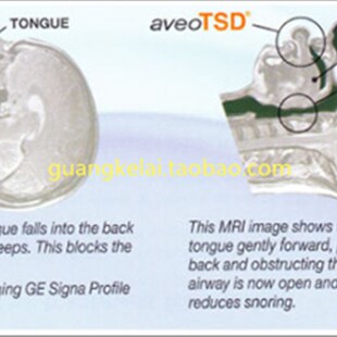 eoTD含舌止鼾舌 舌后缀 憋气 呼吸暂停 止鼾舌