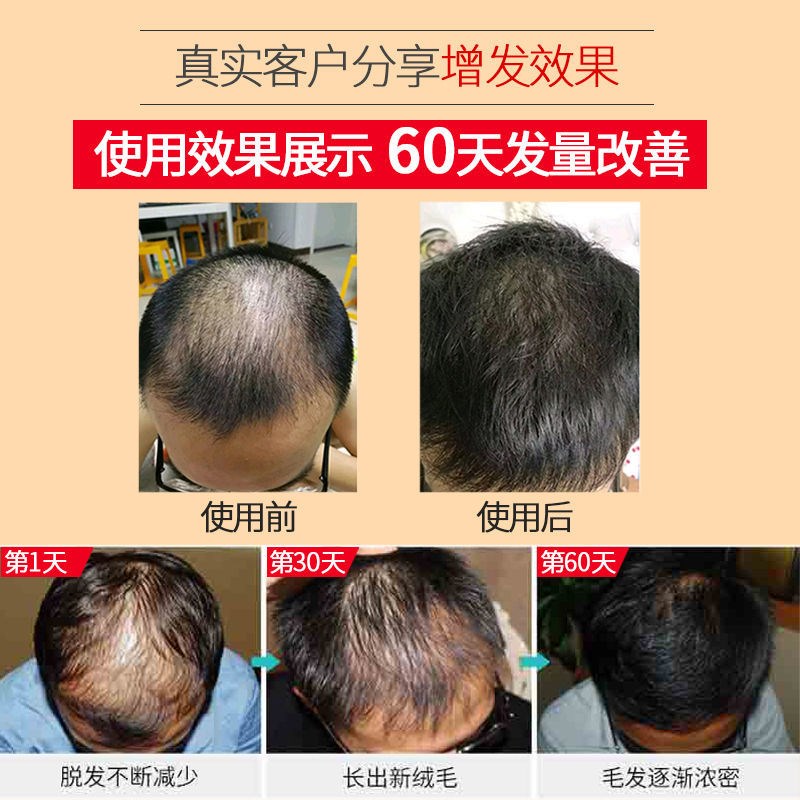 头发增长液生发剂加快速短发留长神器增发密发浓密防脱护发精华液