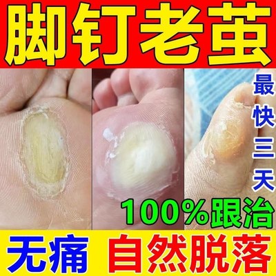 脚钉祛除膏去除j厚脚垫老茧死皮根去脚底板脚掌趾指头硬皮软化剂