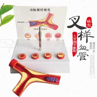 支脉粥样硬化 心血管动脉硬.化模型 血栓.形成模型人体血管模型