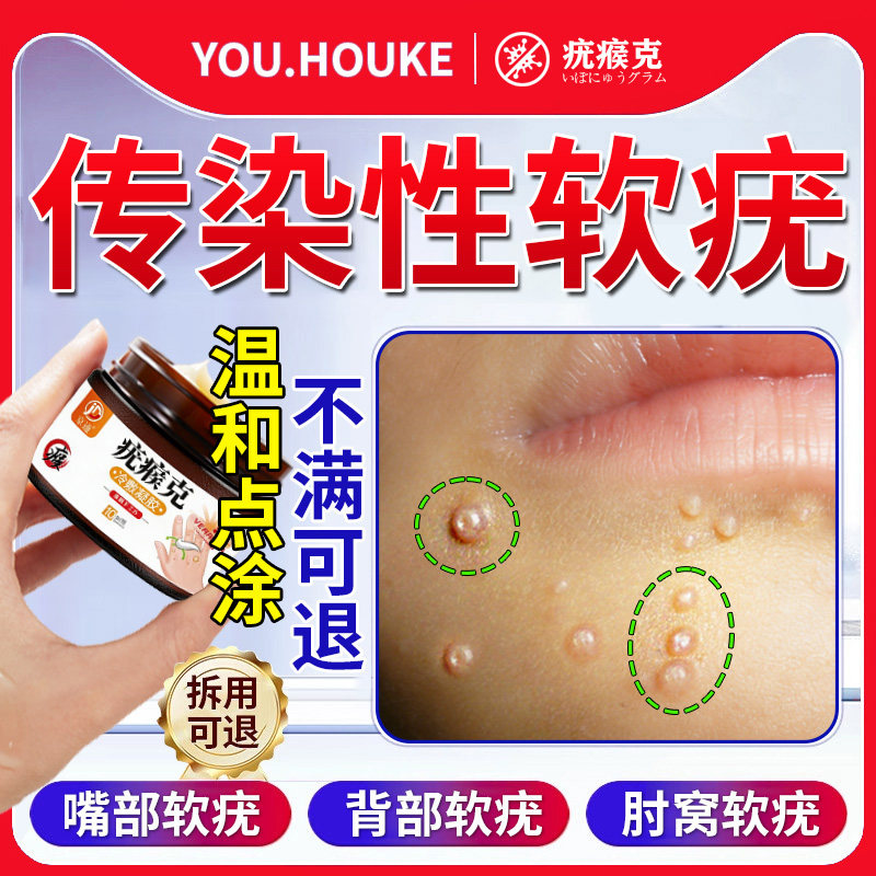 传染性软疣儿童成人病毒性水猴子非药膏疣瘊肉粒非一抹无忧去除膏