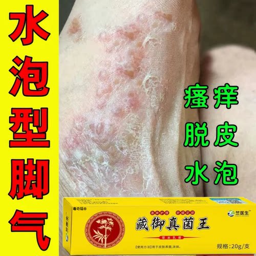 【十年脚臭气】一支搞定