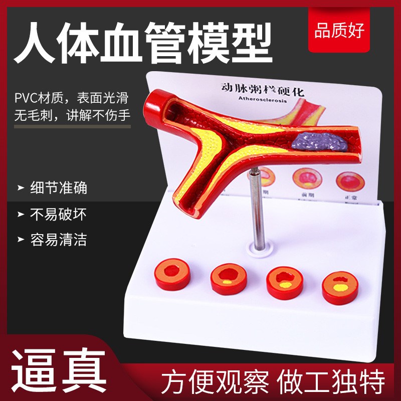 血管堵塞动支脉粥样 硬化心血管动脉硬化模具 血管X病理模型血栓