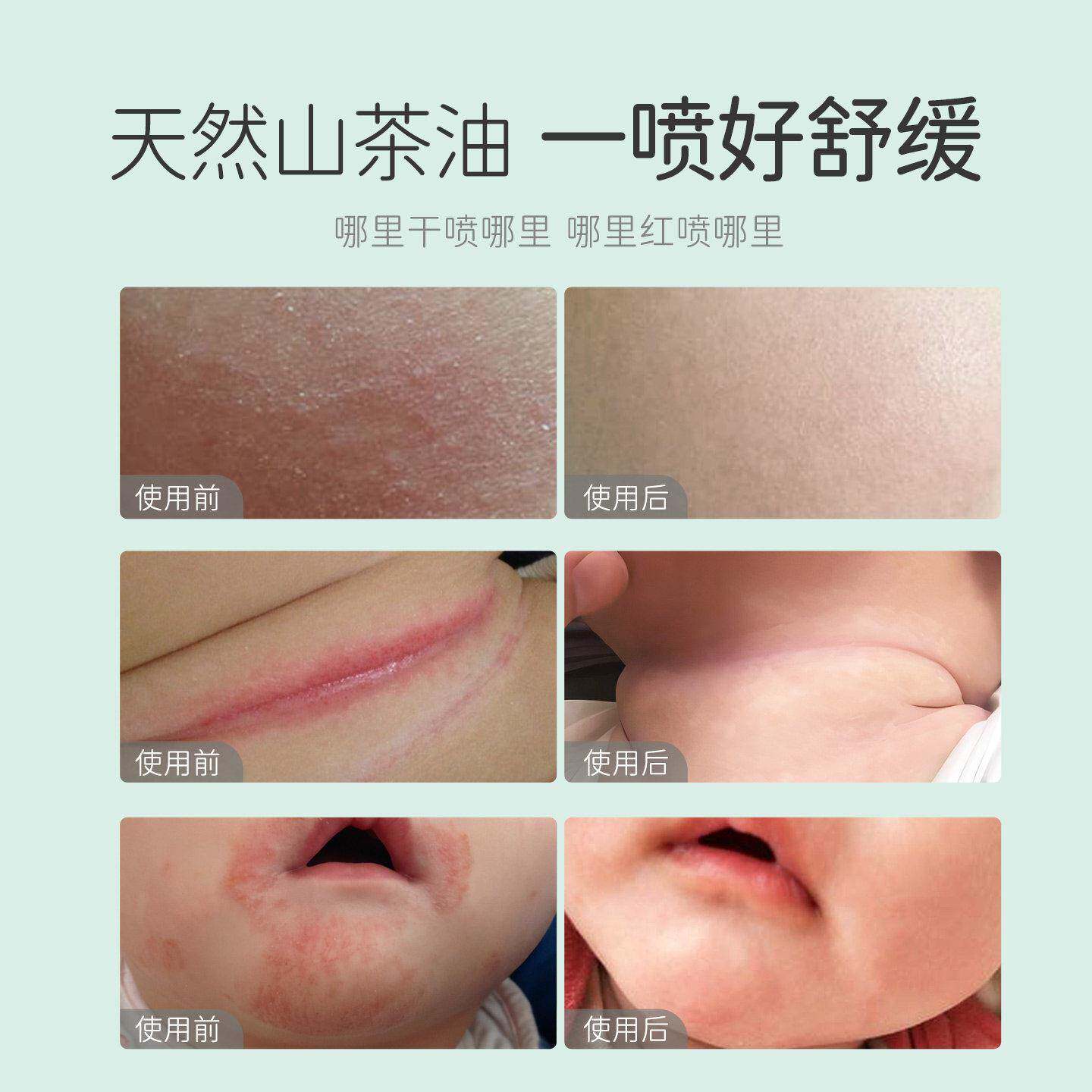 婴护肤山茶护臀儿膏宝宝红屁屁润肤油抚触新生屁841股护理专油用