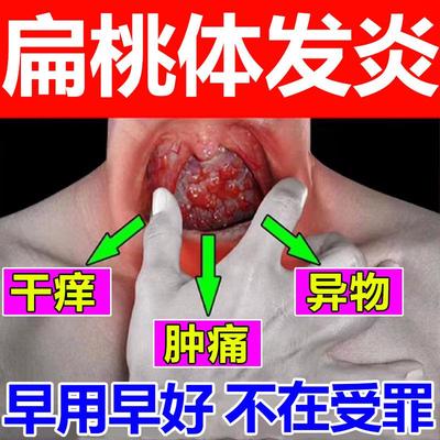 扁桃体发炎特效喉咙肿痛儿童嗓子疼治疗肥大有痰咳嗽有异物感的药