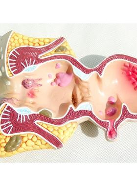 直肠内痔疮病变模型痔FCT疮门外解剖肛肛肠科大肠直肠病理模型