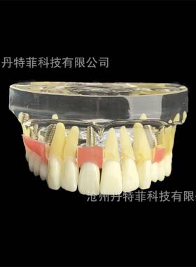 M2005牙齿模型种植牙模型牙齿种植演示模型医患沟通模型