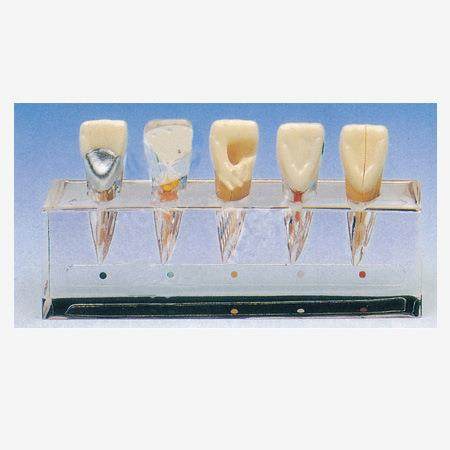 牙髓临床模型B10015/1