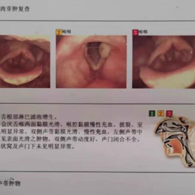 沙声肉嘶音不肉结肥厚声哑咽痛带炎全发接触费劲闭合性芽肿物小息