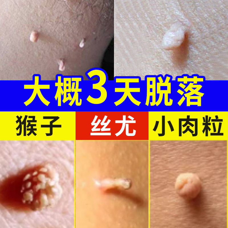 去尤瘊小肉粒疙瘩去脖子上脸上胳肢窝猴子一抹无忧皮赘神器膏除