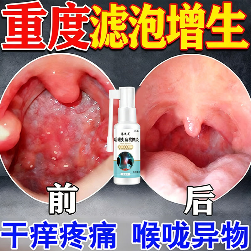 治疗喉咙滤泡增生咽炎慢性咽喉炎异物感ii专化痰咳嗽干呕用hr