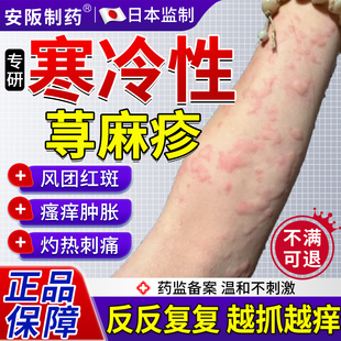 寒冷性寻荨麻疹过敏止痒专特治疗断风团效红斑根用皮肤瘙痒膏KY