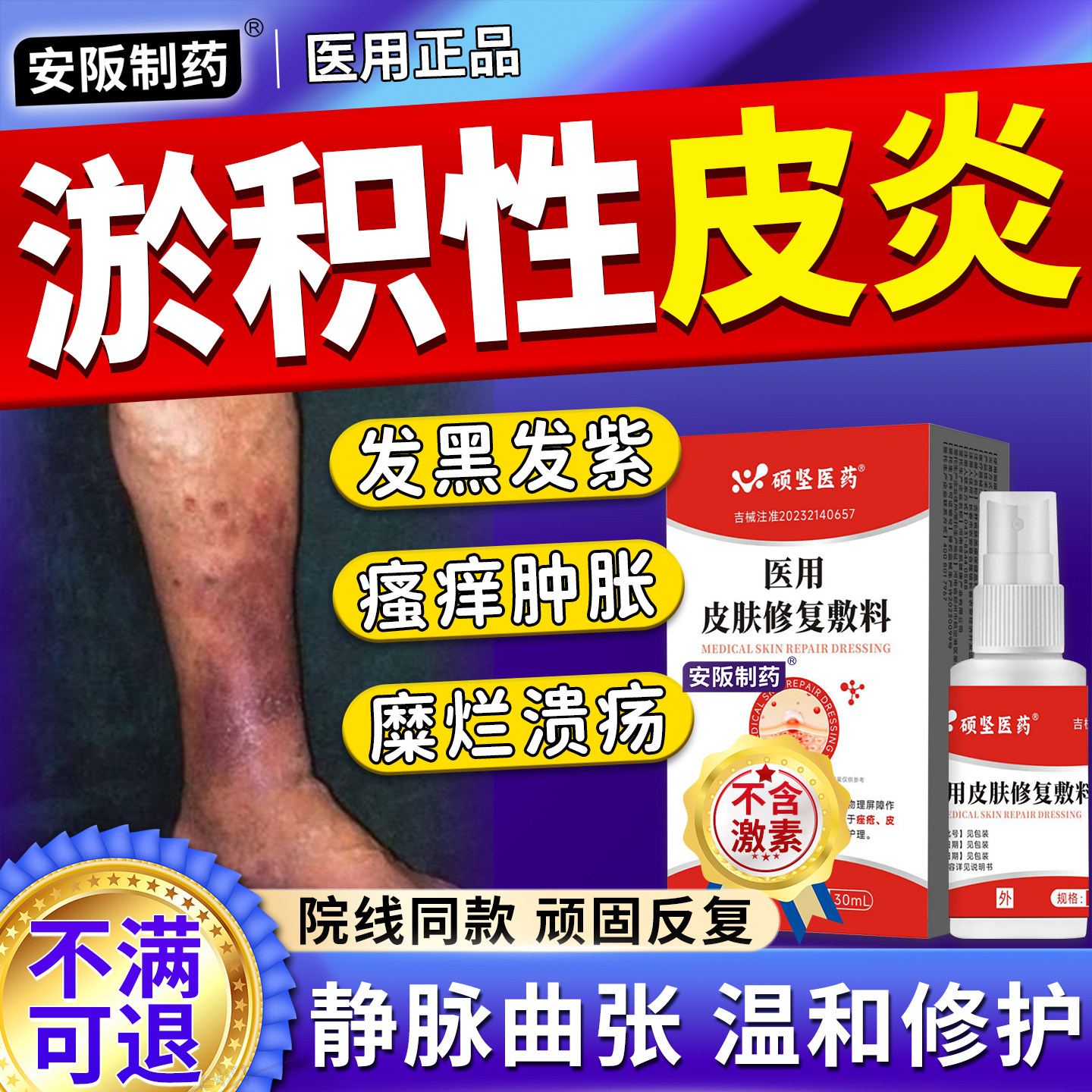 淤积性皮炎专小腿硬化静脉炎用老烂腿静脉曲张药膏湿疹止痒喷剂KY