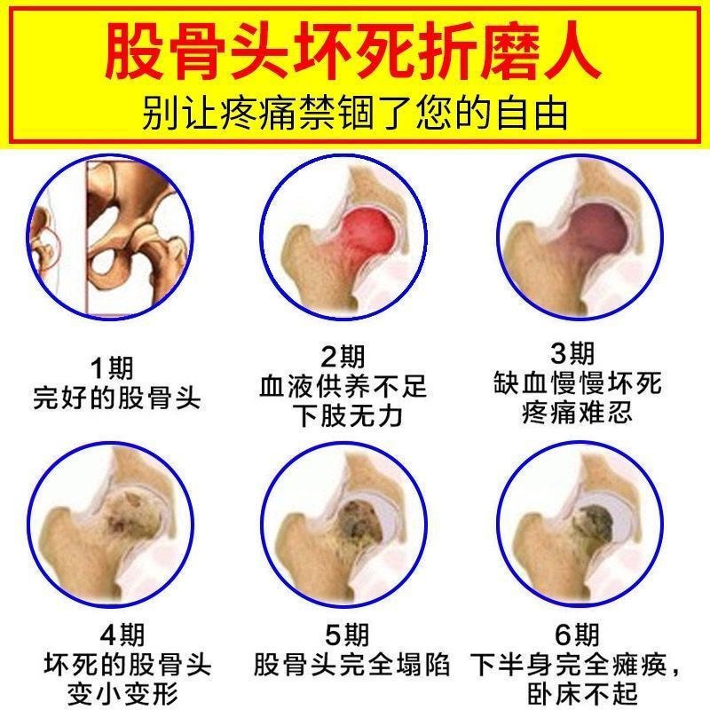 髋关节股骨头疼痛贴大腿屁股疼尾椎疼髋关节发炎疼痛跛行塌陷贴膏