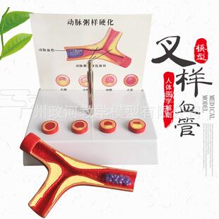 支脉粥样硬化心血管动脉硬.化模型血栓.形成模型人体血管模型