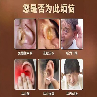 耳鸣嗡嗡响专用药贴】耳鸣痛痒治疗贴神经性耳鸣专调耳嗡专用贴敷