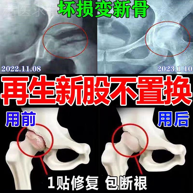 股骨头修复髋关节疼痛专用积液塌陷缺血性坏死专用走路坡行疼痛贴