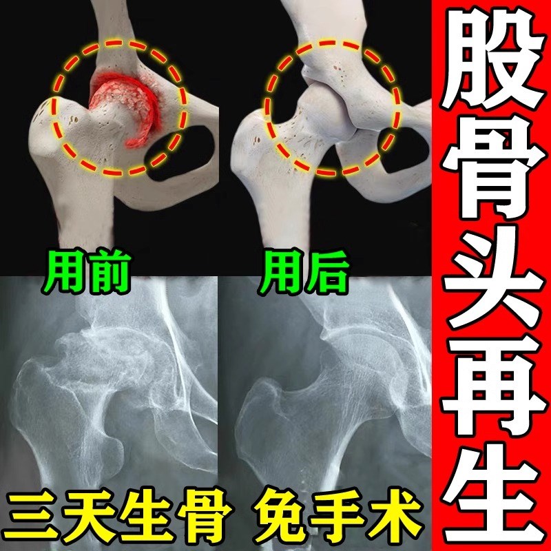 【坏死修复】股骨头坏塌陷跛行缺血无菌性髋关节胯部胯骨疼痛贴