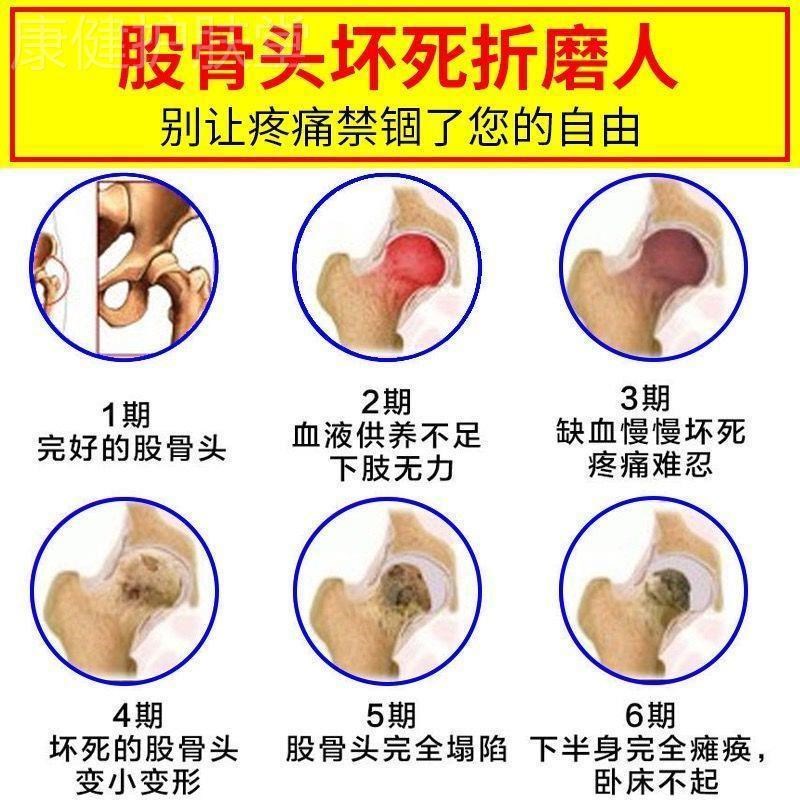 髋关节股骨头疼痛贴大腿屁股疼尾椎疼髋关节发炎疼痛跛行塌陷贴膏