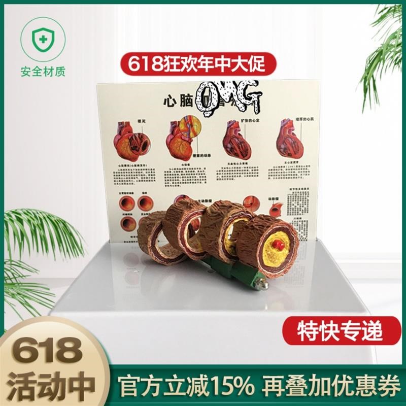 教学彷真血d管模型活动血管阻塞模型血E栓病变标本4阶段性动脉O硬