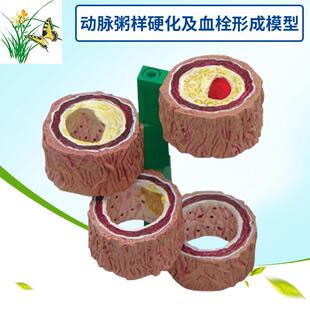 动脉/粥样硬化及血栓/形成模型四阶段血管/硬化过程模型