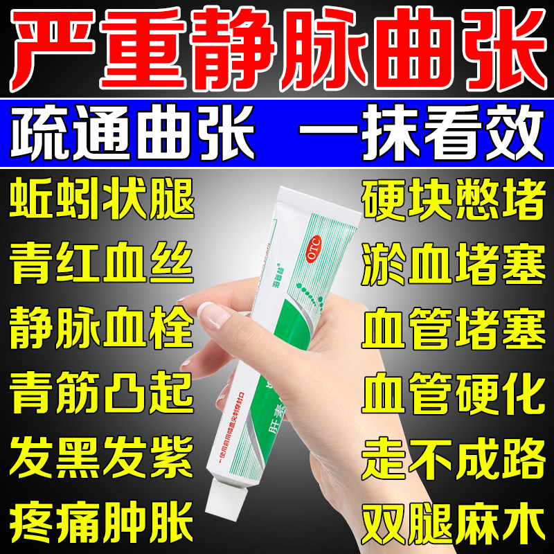 静脉曲张特新效期专用药膏静脉炎青筋凸起血管肿胀肝素钠乳膏正品