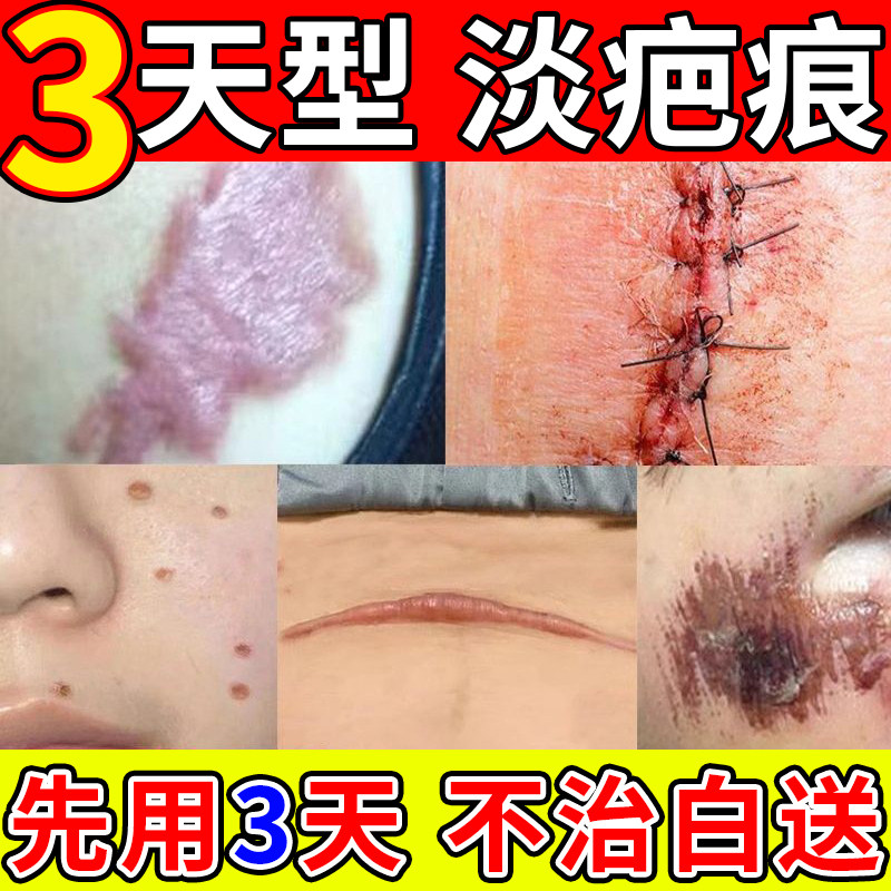 金力康花半伴夏硅酮祛疤凝胶膏成人创伤烧烫剖腹产妊娠纹增生手术