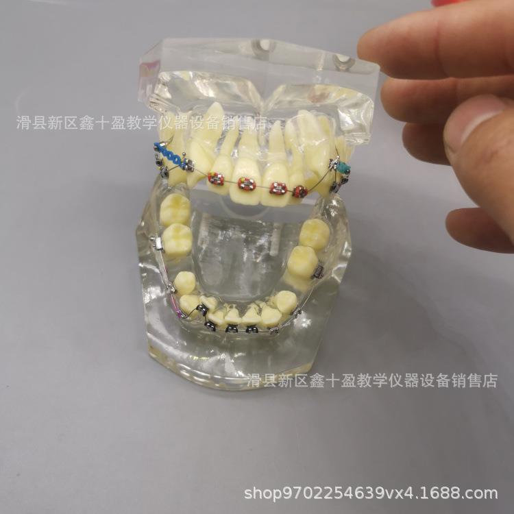 牙齿9580正列畸型缺失牙颌牙不齐矫错正模金属托槽带支抗牵引皮拉