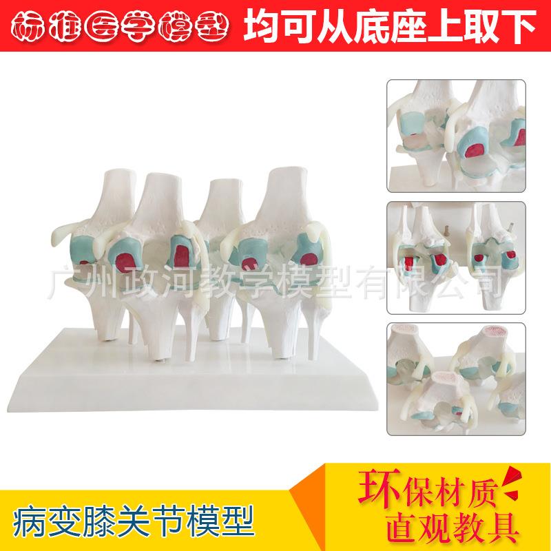 四分型膝关节正常与膝盖骨病变组合模型人骨架模型人体模型