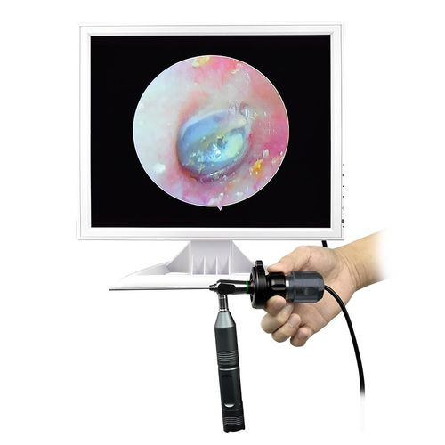 可视采耳设备仪器耳鼻喉专业内窥镜掏耳朵专用观察仪一体机