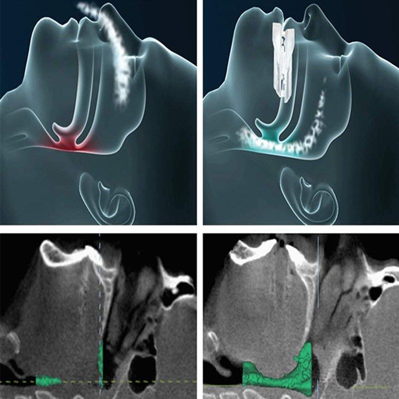 止鼾牙套神器阻止打鼾打呼噜止鼾器呼吸暂停口腔矫治器机防呼噜消