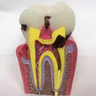 牙科牙齿模型6671倍龋齿对医比口腔患沟沙通教学立教具盘体多功能