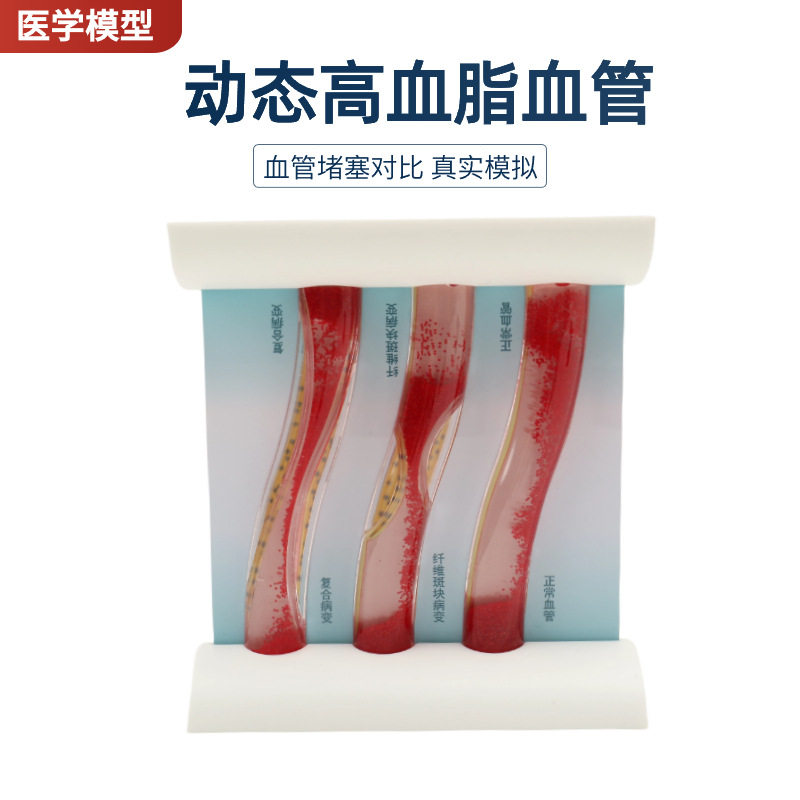 动态高血脂血管堵塞对比模型 病态血管浓稠度对比解说血管模型