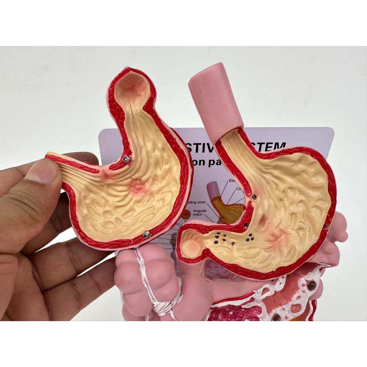 人体消化系统胃病理穿孔胃溃疡肠理病变大肠盲肠十二指肠教学