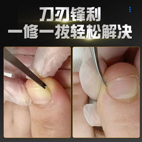 修甲沟炎专用镊子拔嵌甲钳专业修脚工具足浴修脚店家用不锈钢夹子