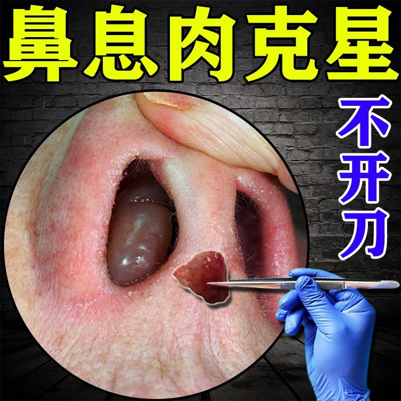 鼻息肉鼻窦炎【不开刀自动脱落】鼻子堵塞鼻甲疏通鼻息肉鼻堵塞贴,居家日用,鼻罩,淘宝优惠券,粉丝福利购,淘宝优惠卷