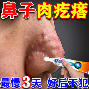 鼻子皮脂腺增生鼻翼上肉疙瘩长痘痘火疖子上火红肿酒糟鼻专用膏药